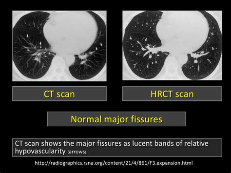 Figure 3 Sign Fleischner Sign Fissure Sign Headcheese Sign Hilar Over