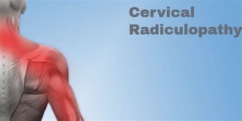cervical radiculopathy symptoms and treatments legacy spine and neurological specialists