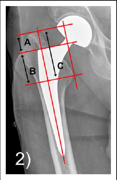 Anteroposterior Plain Radiograph Of A Right Hip Showing The Measured