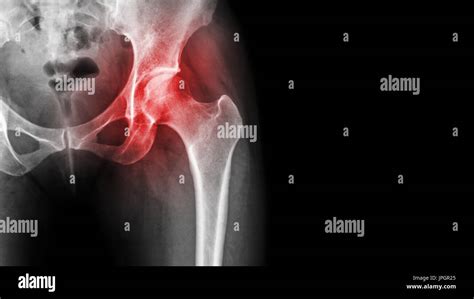 Arthritis At Hip Joint Film X Ray Show Inflamed Of Hip My XXX Hot Girl