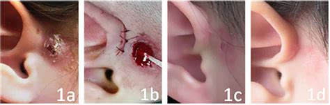 Preauricular Pit Infection