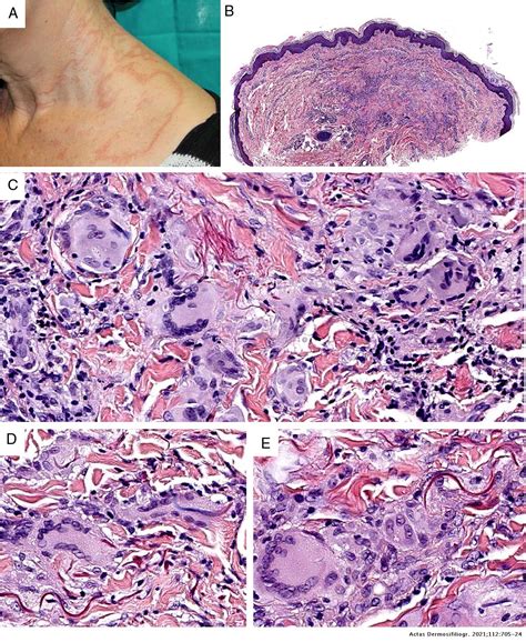Granulomas In Dermatopathology Principal Diagnoses — Part 2 Actas