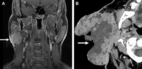 Pitfalls In The Staging Of Cancer Of The Major Salivary Gland Neoplasms