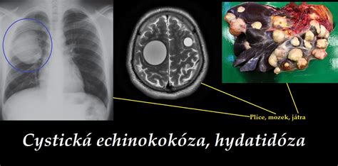 Cystická Echinokokóza Hydatidóza Příznaky Projevy Symptomy Léčba