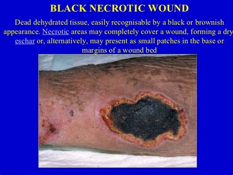 The black would be powder burns especially it the gun was close to the wound. Bohomolets 2nd year Surgery Wounds