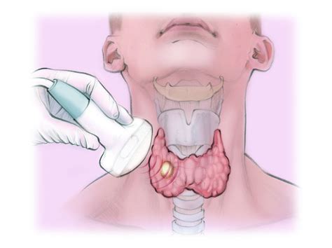 Thyroid Biopsy The Interventional Initiative