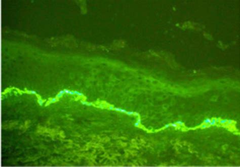 Severe Bullous Pemphigoid With Excoriation Disorder Bmj Case Reports