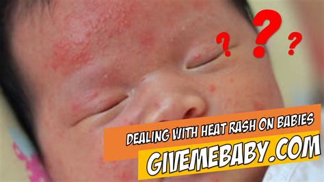 Dealing With Heat Rash On Babies Heat Rash Baby Rash Baby Heat Rash