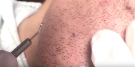 Video Man Extracts Ingrown Hair That Looks Like Blackhead