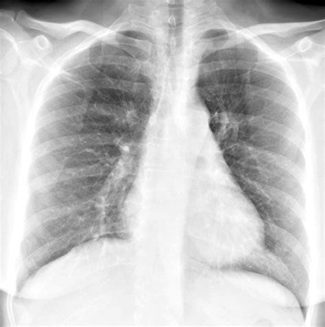Bronchitis Chest X Ray Bronchitis Contagious