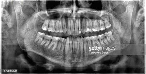 Human Skull Teeth Photos And Premium High Res Pictures Getty Images