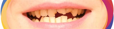 Broken Cracked Tooth Addc Dental Call 08 9276 1540