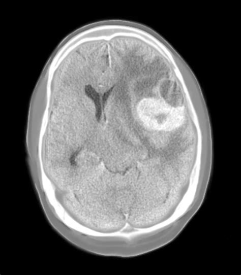 Brain Cancer Ct Scan Photograph By Du Cane Medical Imaging Ltd Pixels