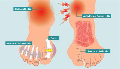 10 Main Causes Of Foot Pain New Life Ticket