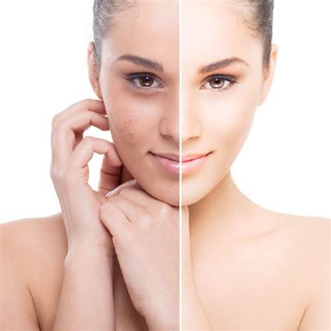 Frequent Facial Treatment New York Skin Solutions