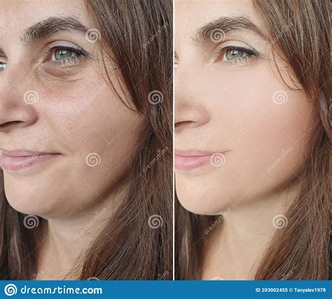 Woman Face Wrinkles Regeneration Tightening Before And After Hydrating