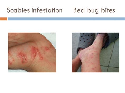Bed Bug Bites Vs Scabies