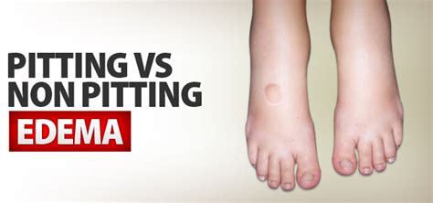 What Is 4 Pitting Edema 4