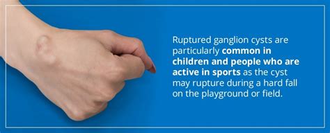 What To Do When A Ganglion Cyst Ruptures Orthobethesda