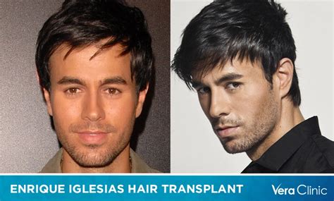 Enrique Iglesias Hair Transplant His Hair Loss Journey