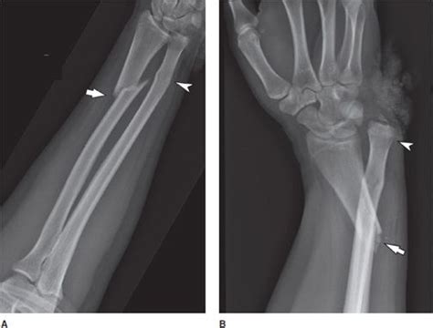 Upper Extremity Fracture