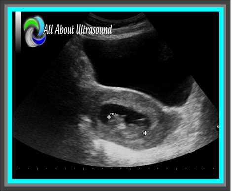 Best Practice Tips To Ob Gyn Ultrasound