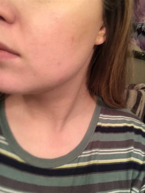 Acne Cysts On Chin And Jawline Advice Please Skincareaddiction
