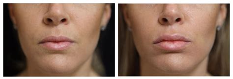 Lip Augmentation Options Such As Restylane And Juvederm Volbella