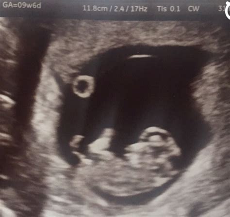 It's used to see how far along in your pregnancy you are and check your baby's development. 8 Weeks Scans - Can i see your pictures please - Netmums Chat