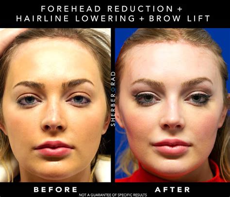 Forehead Reduction Washington Dc Receding Hairline Northern Va