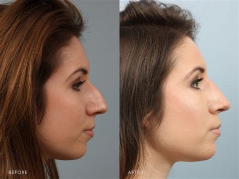 Nose Tip Reshaping Rhinoplasty Surgery Williams Center Williams Center