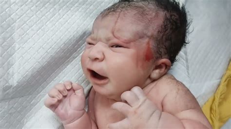 Big Poor Newborn Baby Born Via Forceps With Marks On Forehead