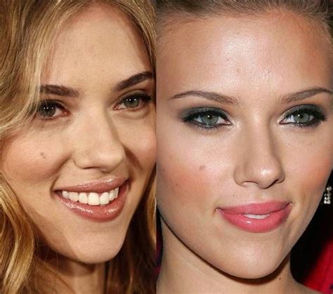 26 Celebs Before And After Their Plastic Surgerywow Celebrity