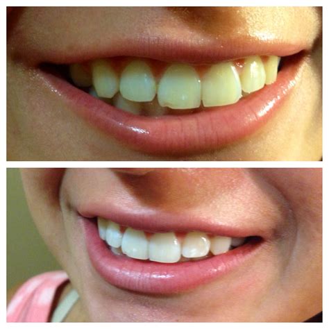 Before And After Teeth Whitening Skin Solutions Corona