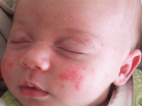 Baby Acne Treatment Guide For Treating Baby Acne Naturally