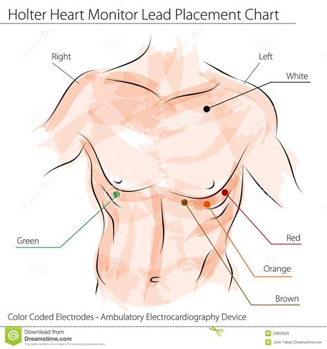 Holter Heart Monitor Lead Placement Chart Royalty Free