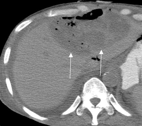 Us Of Liver Transplants Normal And Abnormal Radiographics