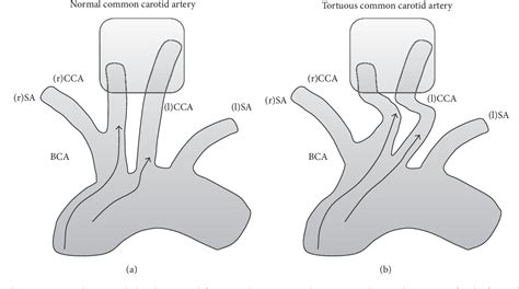 Figure 1 From Tortuous Common Carotid Artery A Report Of Four Cases