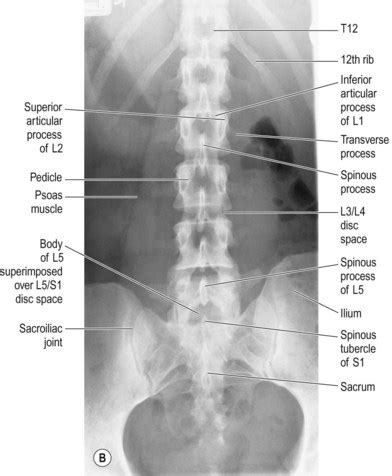 Lumbar Spine Ap View Labelled Radiographic Anatomy My XXX Hot Girl