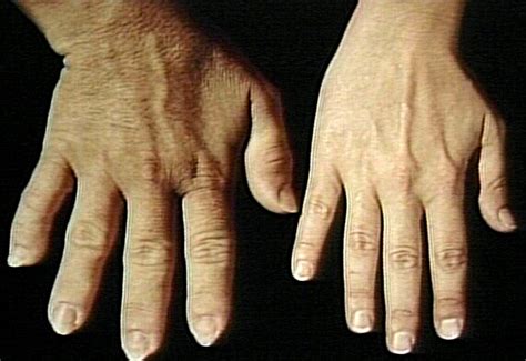 Acromegaly Causes Symptoms Treatment Pictures Definition