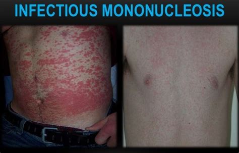 Infectious Mononucleosis Skin Rash Ask Hematologist Understand