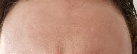 Skin Concerns What Causes This Patchy Redness Skincareaddiction