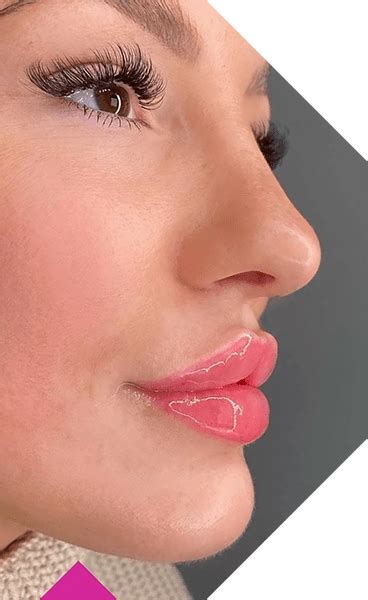 Russian Lip Filler Technique Skinly Aesthetics