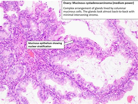 Ovary Mucinous Carcinoma Mucinous Cystadenocarcinoma Nus Pathweb