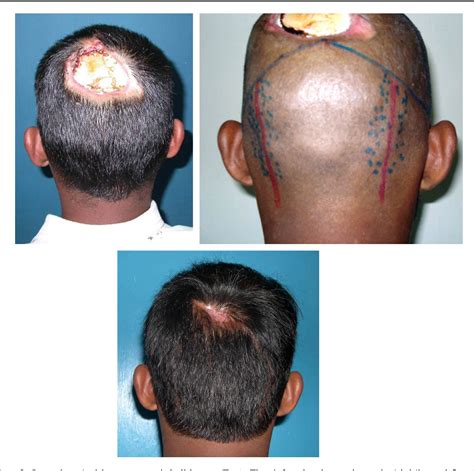 Figure 4 From Occipital Artery Island V Y Advancement Flap For