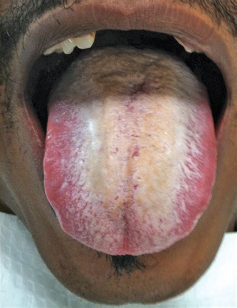 Treatment For Black Hairy Tongue Dimensions Of Dental