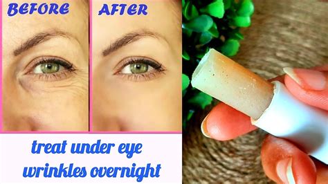 How To Get Rid Of Wrinkles Remove Under Eye Wrinkles And Dark Circle