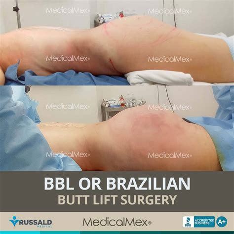 Brazilian Butt Lift Surgery In Tijuana Mexico Medicalmex