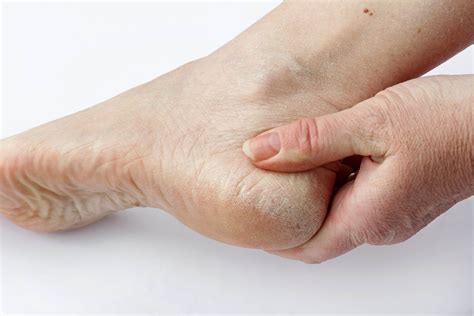 Dry Skin And Foot Problems Your Total Foot Care