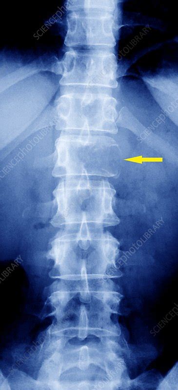 Metastatic Bone Cancer X Ray Stock Image C0071624 Science Photo